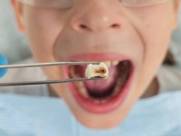 Best Emergency Wisdom Tooth Extraction in Biscoe, NC